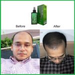 Green Wealth Neo Hair Lotion 120ml Original Hair loss Treatment & Regrowth - Image 4