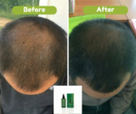 Original Neo hair Lotion Full Package ( 3+3 ) Hair Loss & Regrowth - Image 5