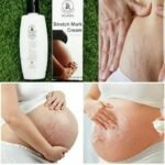 Dr. James Stretch Mark Cream - Image 3